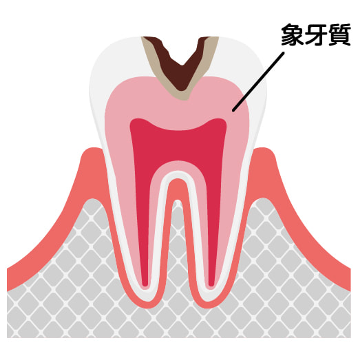 C2 中度の虫歯
