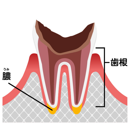 C4 最重度の虫歯